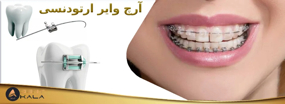 آرچ وایر ارتودنسی