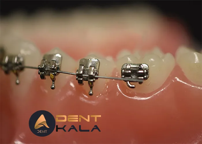 تصویر سیم ارتودنسی کواکسیال چند رشتهای مناسب درمان دندانهای نامرتب