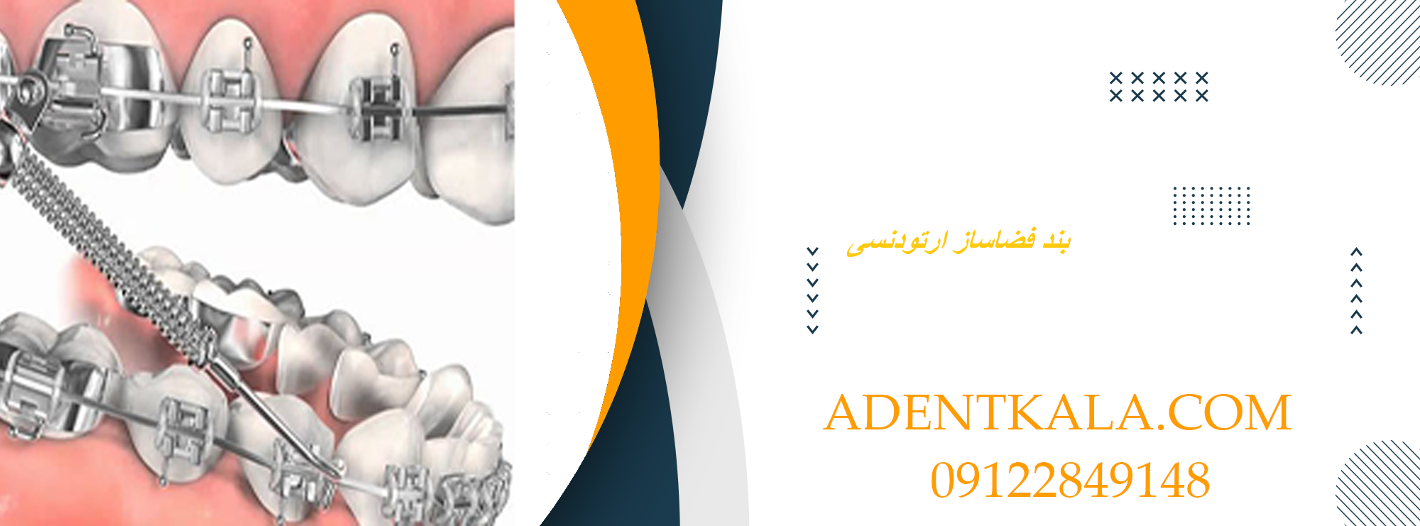 بند فضاساز ارتودنسی اطفال