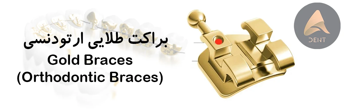 براکت طلایی (Gold Braces)