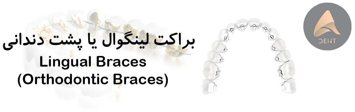 براکت لینگوال یا پشت دندانی (Lingual Braces)