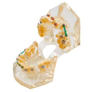 مولاژ دندان ارتودنسی | Dental mollage